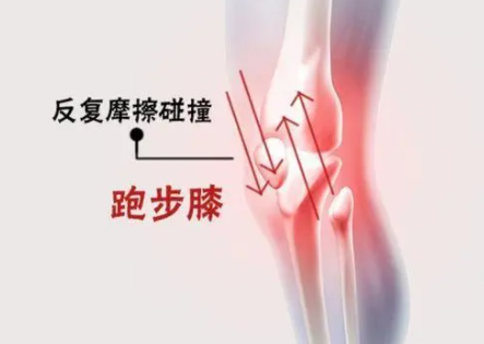 缓解跑步膝,跑步膝疼痛